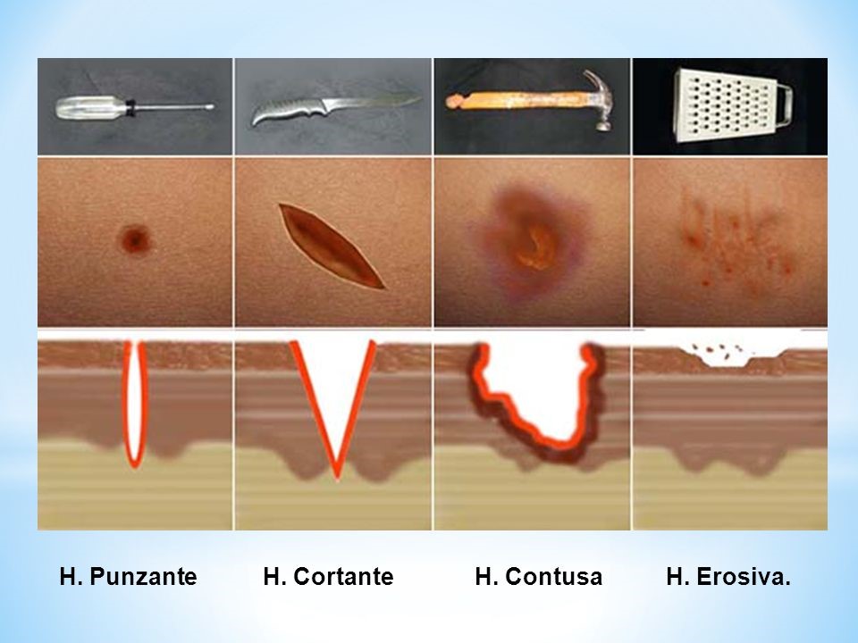 Cuáles son los tipos de heridas que existen? - Noticias europeas